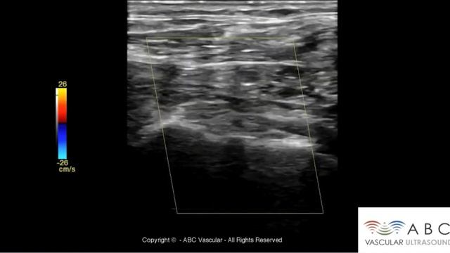 Subclavian artery complete steal syndrome (colour flow Doppler). Carotid Doppler | Ultrasound смотреть онлайн