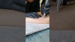 Удаление татуировки лазером