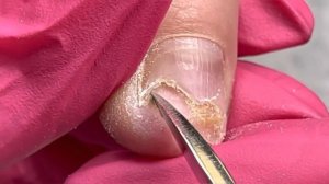 Онихолизис Виктория Авдеева