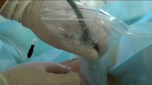 Аксиллярная блокада плечевого сплетения