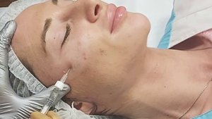 АирисКом студенты учатся: филлеры для увеличения скул.