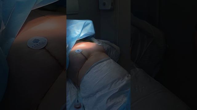 Маммопластика / якорная подтяжка груди без имплантов / результат операции