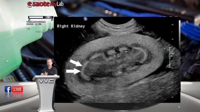 VVC Virtual Studio -Отравяне с Етилен Гликол - Facebook LIVE смотреть онлайн