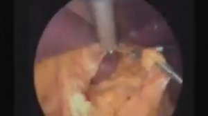 Ультразвуковые ножницы 55 кГц Фундопликация