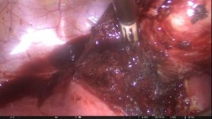 лапароскопия, субмукозная миома матки#fibroid uterus