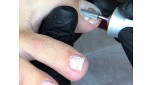 Самые распространенные болезни ногтей