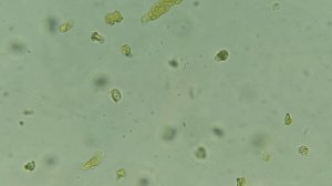 почечный эпителий в осадке мочи