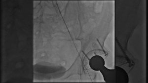 Стентирование артерий нижних конечностей