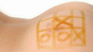 Как быстро и безболезненно избавиться от шишек от уколов! 5 эффективных способов!