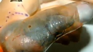 Укус шпильковой змеи истории людей