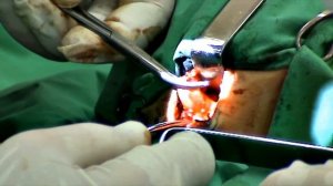 Rzayev R.M. Киста щитовидно-язычного протока (срединная киста шеи)