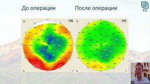 7. Комбинированная хирургия катаракты при нерегулярном астигматизме роговицы. (А.В. Демидов, Казань)