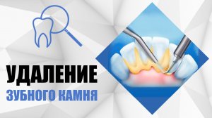 Удаление зубного камня - ультразвуковая чистка зубов [ зубной камень ].