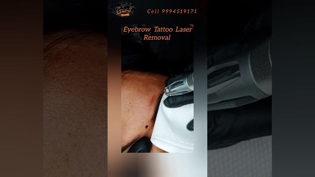 Eyebrow Tattoo Laser Removal  #eyebrowtattoo #youtubeshorts #lasertreatment #eyebrowtattoo #trendin