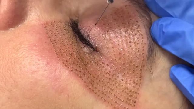 Plasma Pen Eye Lift смотреть онлайн