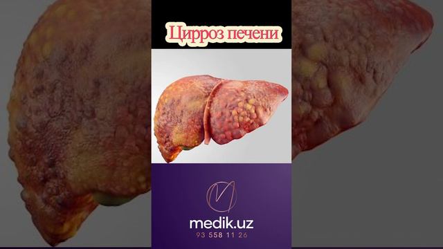 Цирроз печени #циррозпечени #заболевание