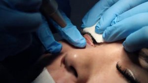 Лазерное удаление Ксантелазмы век