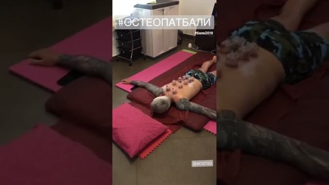 Хиджама на Бали с Эви Сударто.