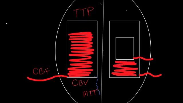 Introduction to CT perfusion before Call. смотреть онлайн
