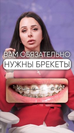 А вы планируете устанавливать брекеты? #брекеты #стоматология #стоматолог