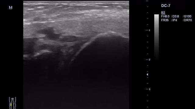 Киста мениска