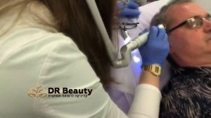 Удаление кератозного новообразования Dr Beauty