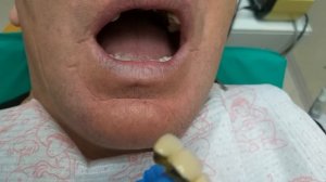 Последствия протезирования в Китае.