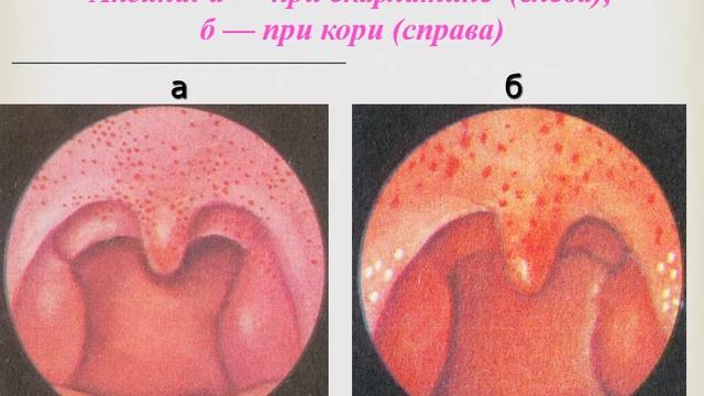 Клинические особенности строения и функции глотки. Острые и хронические заболевания глотки.