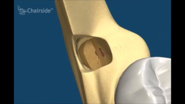 Как проходит удаление зуба Как удалить зуб Видео по стоматологии смотреть онлайн