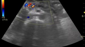 Хр.калькулезный панкреатит