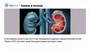 Сколько времени выходит камень из почки?