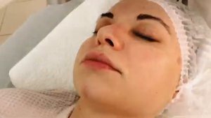 Удаление сосудистых звездочек, купероза лазером