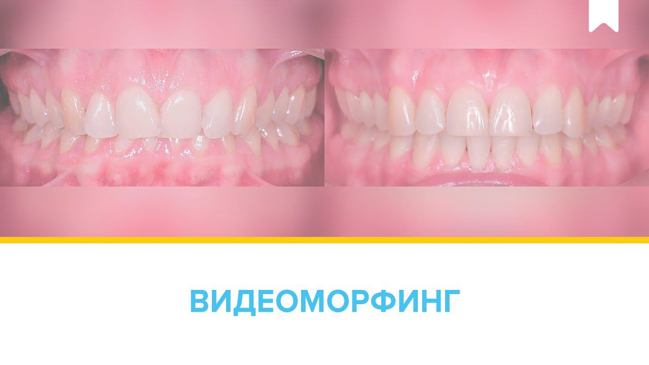 Лечение глубокого прикуса у "возрастной" пациентки цифровыми брекетами INSIGNIA за 2 года!
