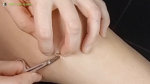 Как снять ШВЫ ДОМА после артроскопии | How to remove stitches at home after arthroscopy