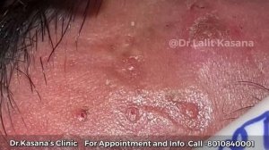 Best Blackhead Removal by Dr.Lalit Kasana  / pimple popping /Dr.Kasana’s Clinic