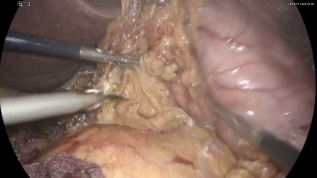 Laparoscopic distal gastrectomy / Дистальная субтотальная резекция желудка с лимфодиссекцией Д2