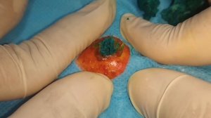 BEST Pimple Popping // Big Cystic Acne Blackheads // Whiteheads Removal  // Squeezing Pimples #026