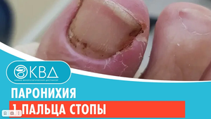 ? Паронихия 1 пальца стопы. Клинический случай №362