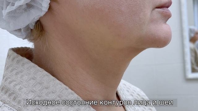 Нитевой лифтинг лица и шеи