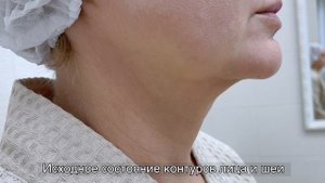Нитевой лифтинг лица и шеи