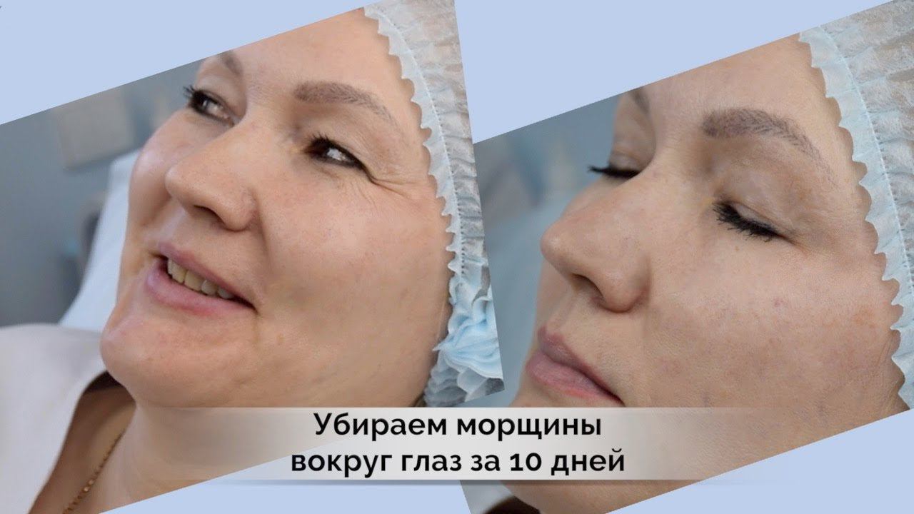 Как убрать морщины за 10 дней? Ботулотоксин удаляет мимические морщины.