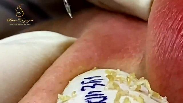 Professional Bleckheads   Выдавливание черных точек прыщей   самое залипательное видео 2023