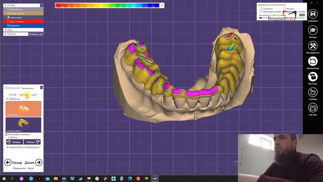 Изготовление окклюзионной шины в цс, параметры артикулятора. Латеротрузия, протрузия. смотреть онлайн