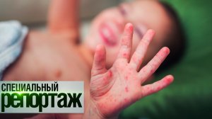 Детская чума из СССР. Возращение смертельной кори || Специальный репортаж