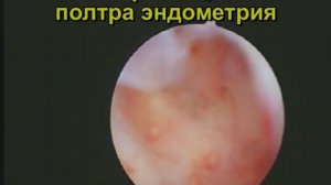 «Труднодоступный» полип эндометрия. Удаление.