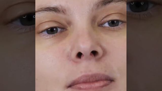 Удаление сосудов лазером (продолжение) смотреть онлайн