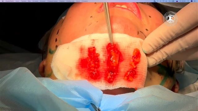 Дискуссия «Хирург или косметолог? Два взгляда на одну эстетическую проблему» смотреть онлайн