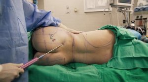 Patient Wanted Kylie Jenner’s Body -  360 Liposuction + BBL Transformation