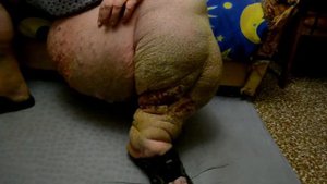 Осторожно ЛИМФОСТАЗ: Человек со слоновой ногой!