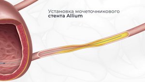 Установка мочеточникового стента Allium